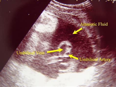 Bildergebnis für normal umbilical cord ultrasound