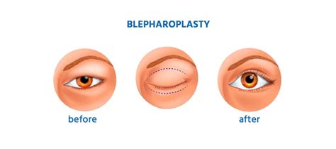 Eyelid Surgery (Blepharoplasty) Cost in India - View Cost