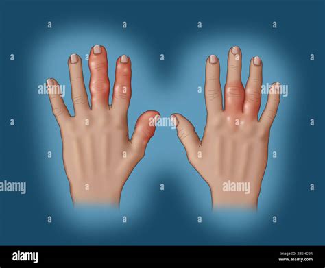 Swollen fingers arthritis hi-res stock photography and images - Alamy
