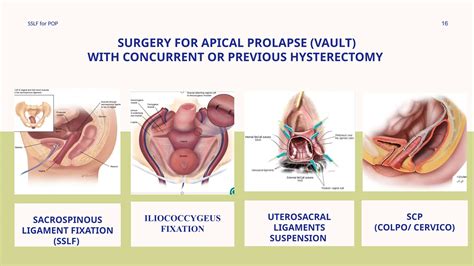 Sacrospinous Ligament Fixation for Pelvic Organ Prolapse - Latest ...