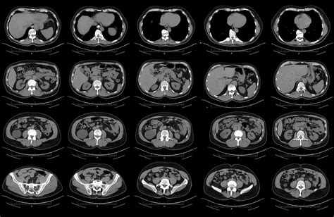 CT scan-reading AI predicts pancreatic cancer early: study