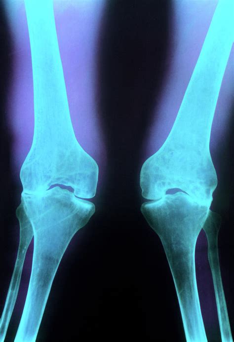 X-ray Of Knee Joints With Rheumatoid Arthritis Photograph by Princess ...