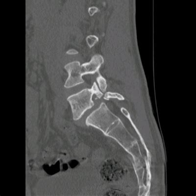 Kuvatulokset haulle pars fracture treatment