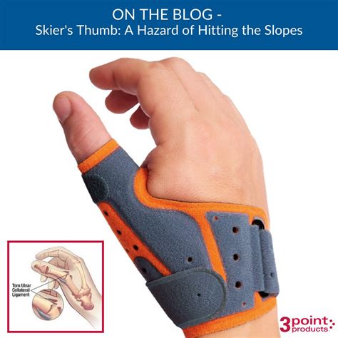 Ulnar Collateral Ligament Thumb Splint