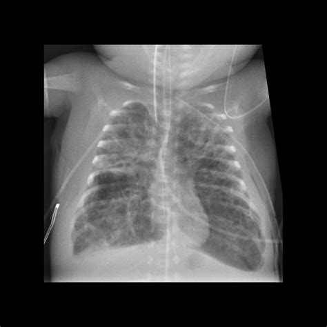 Chest X Ray Findings In Neonatal Respiratory Distress Syndrome at Luz ...