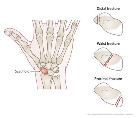 Scaphoid Fracture Test 的图像结果