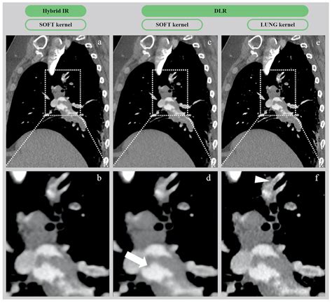 Deep Learning Versus Iterative Reconstruction for CT Pulmonary ...