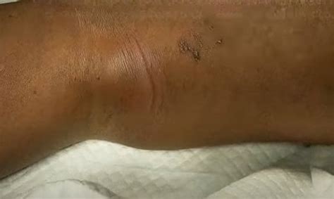 Image result for Exploding Massive Knee Abscess