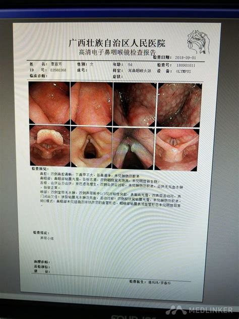 咽喉反流性疾病 一例-医联