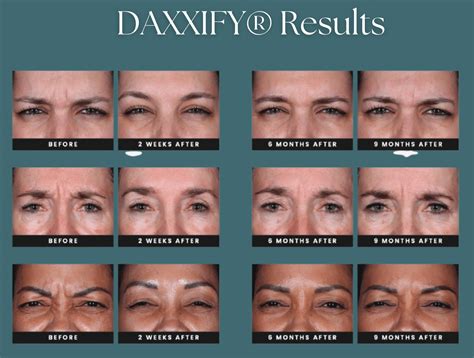 DAXXIFY Injectable Get Rid of Frown Lines Orlando, FL - Altamonte