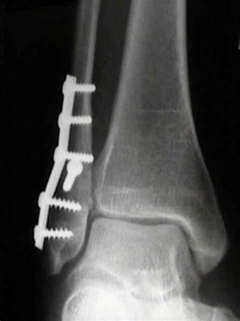 Metalwork Removal - Fracture Info