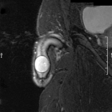 Pediatric leiomyoma of the glans