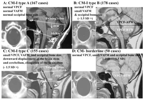 Surgical Management of Chiari Malformation Type I Associated with ...