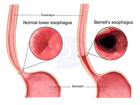 How Often Does Barrett's Esophagus Turn To Cancer