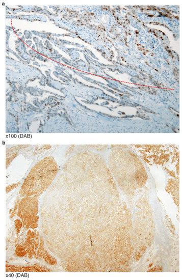 p53 Immunohistochemistry and Mutation Types Mismatching in High-Grade ...