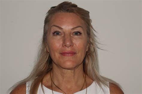 Xerf Facial Rejuvenation | Advanced Skin Renewal Treatment – Elite Med Spa