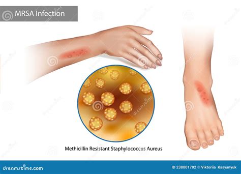 Mrsa Rash On Legs