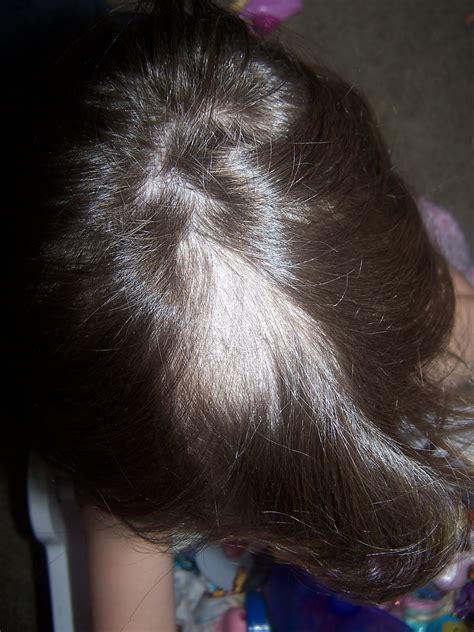 Can Your Scalp Mold at Arthur Popp blog