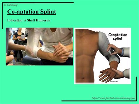 Orthopedic Splints and Casts- Subhadeep PGModules.pptx