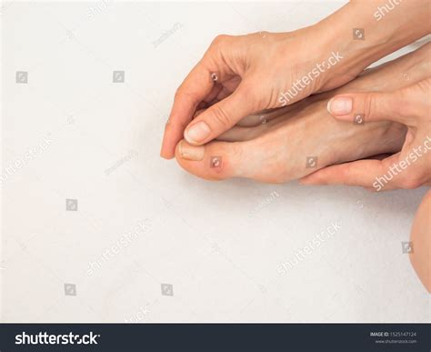 Foot Callus On Finger Close Calluses Stock Photo 1525147124 | Shutterstock
