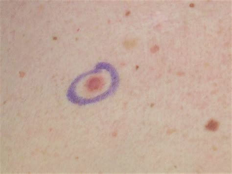 Skin Cancer Archives - Dr. Maral Skelsey