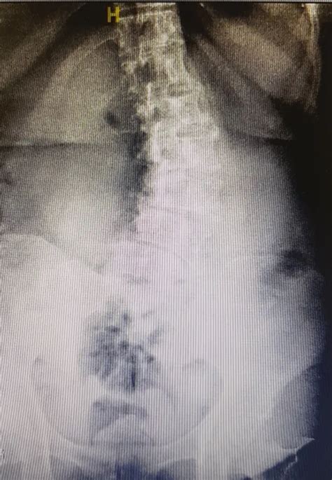 Degenerative scoliosis: The manifestations and treatment options ...