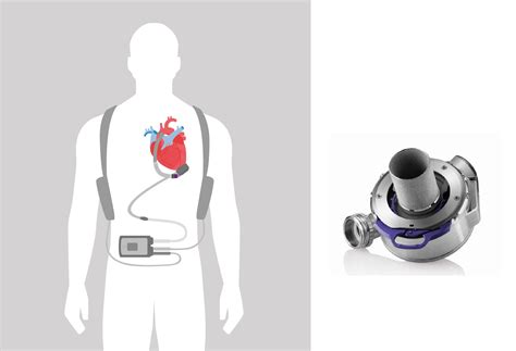 Left Ventricular Assist Device and How it works - The Heart & Vascular ...