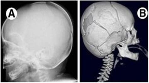 颅骨骨折的影像征象_医学界-助力医生临床决策和职业成长