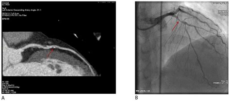 Coronary CT Angiography for Acute Chest Pain in the Emergency ...