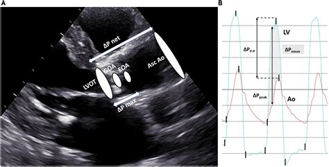 Aortic Stenosis Echo