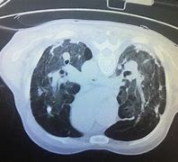 肺气肿 的图像结果