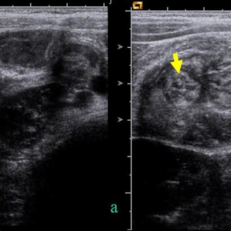 Hydrostatic Reduction of Intussusception 的图像结果