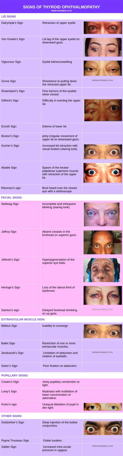Thyroid Eye Signs.