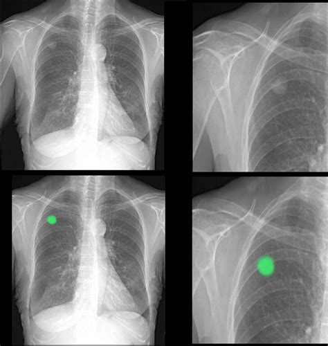 What Is A Lung Nodule