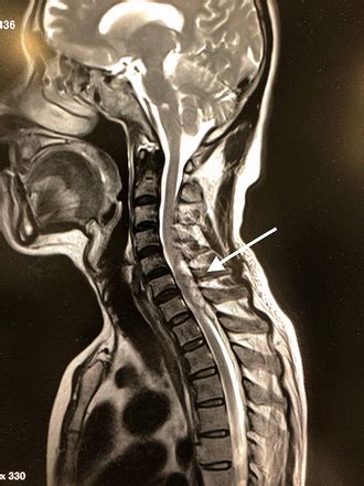 A Case of Spinal epidural haematoma presenting with left shoulder pain