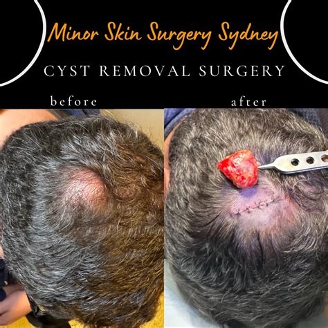 Cyst Removal Videos
