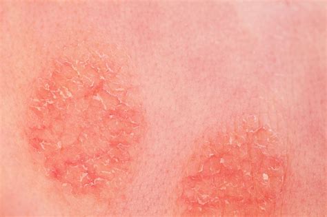 Entzündliche Hauterkrankungen: auf dem Weg zur Präzision - Dermatologie ...