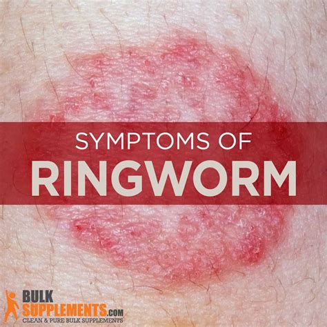 What Is A Honeycomb Ringworm at Hugo Ruse blog