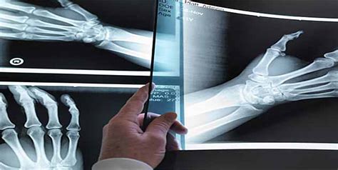 Types of Osteoporosis in Men | OnlyMyHealth