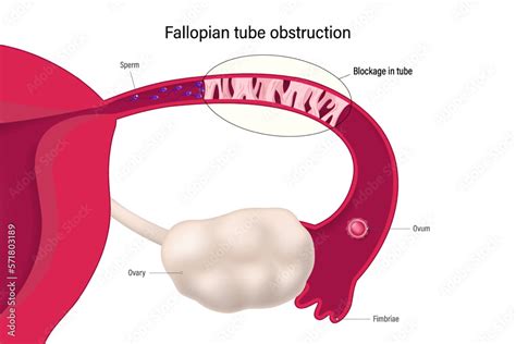 Image result for Cut Off Fallopian Tube