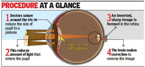 Image result for Pinhole Vision Test