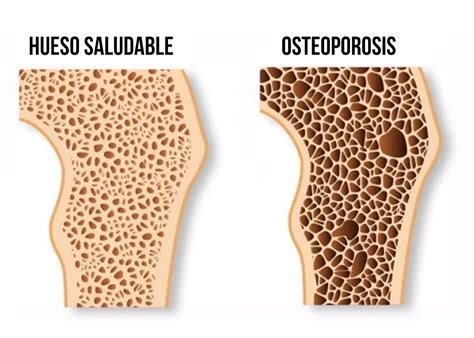 OSTEOPOROSIS Y MENOPAUSIA: Síntomas y tratamiento