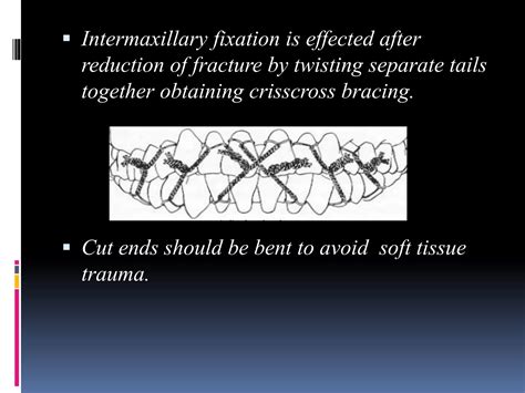 Image result for Intermaxillary Fixation