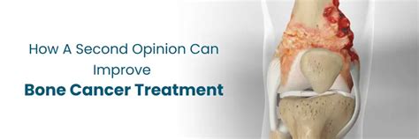 Can Second Opinion Improve Bone Cancer Treatment