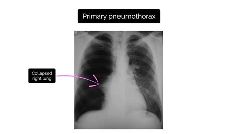 Chest X-ray Interpretation | A Structured Approach | Radiology | OSCE