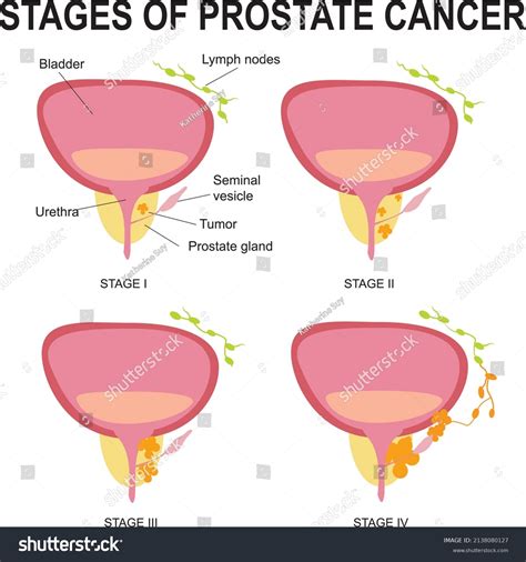 Prostate Cancer 的图像结果