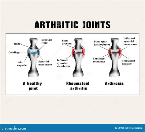 Arthritic Joins (rheumatoid Arthritis, Arthrosis (osteoarthritis)). Stock Vector - Illustration ...