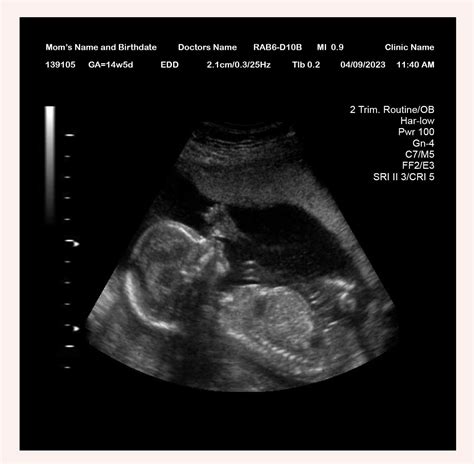 14 Week Ultrasound - Ultrasounds