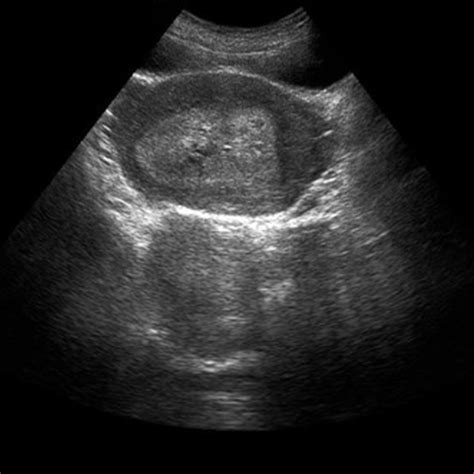 Accuracy of Ultrasound in Diagnosing Retained Products of Conception
