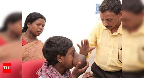 Kochi: 13-year-old encephlocele patient gets life changing surgery at ...